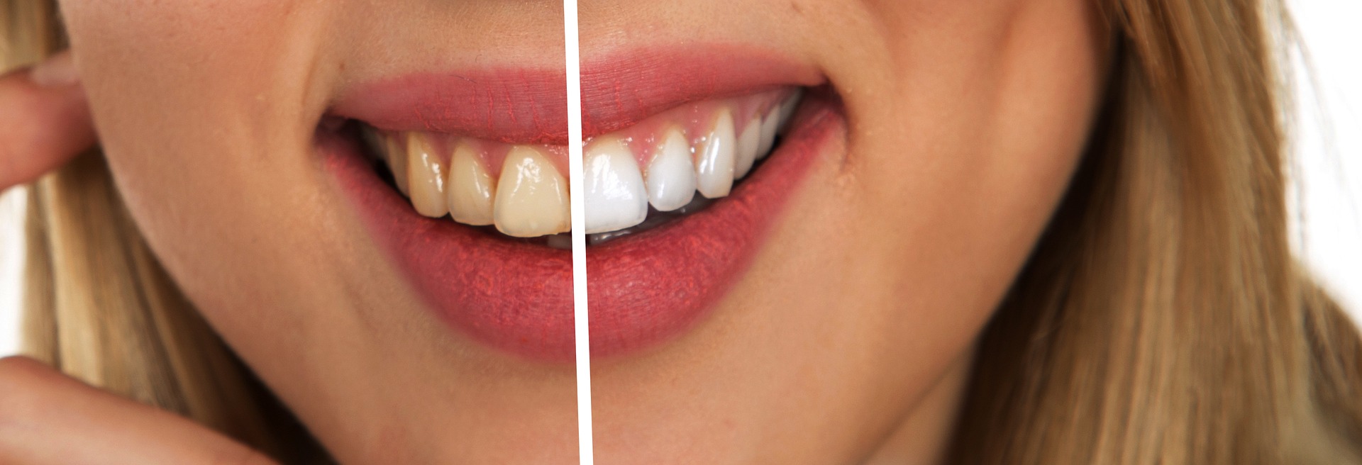 Professional Teeth Whitening for Professional Results