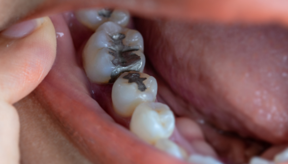 Silver Amalgam Filling Removal and Replacement