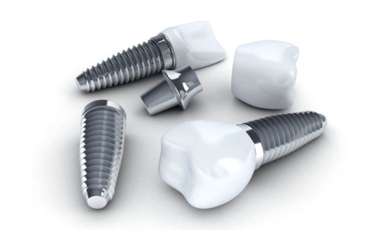 Dental Implants Something to Consider